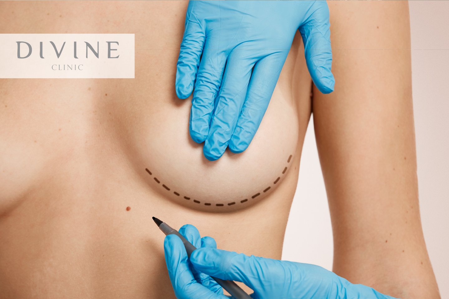 Breast Augmentation